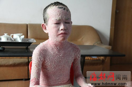 男孩患银屑病全身无完整皮|男孩|银屑病|全身|公