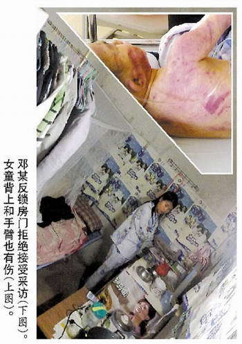 女童背上和手上都有伤