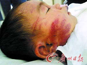 小娟脸上的掌痕清晰可见